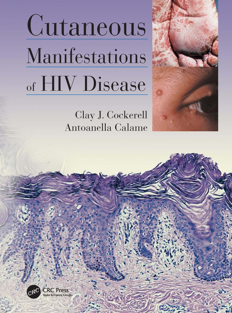 Cutaneous Manifestations of HIV Disease - Antoanella Calame/ Clay Cockerell