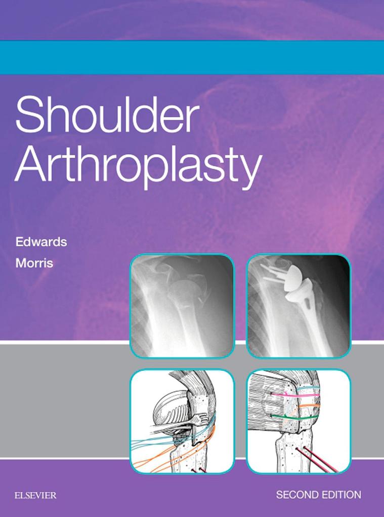 Shoulder Arthroplasty E-Book - T. Bradley Edwards/ Brent J. Morris